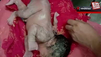 Hindistan'da bir bebek, sırtında ek bir kolla dünyaya geldi