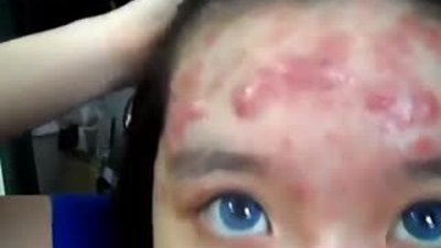 En Kötü Sivilcelere En İyi Makyaj Yöntemi