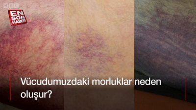 Vücuttaki morluklar neden ve nasıl oluşur?