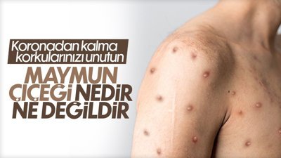 Maymun çiçeği hastalı nedir, belirtileri nelerdir?