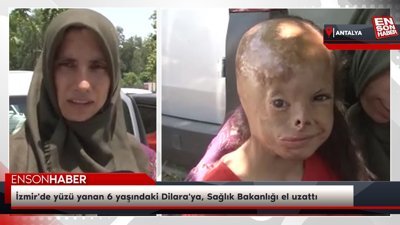 İzmir'de yüzü yanan 6 yaşındaki Dilara'ya, Sağlık Bakanlığı el uzattı