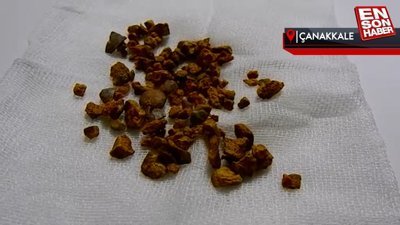 Çanakkale’de kadının böbreğindeki taş, 100 parçaya ayrılarak çıkarıldı