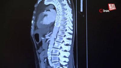 Stres, aort damarında yırtılmaları beraberinde getiriyor