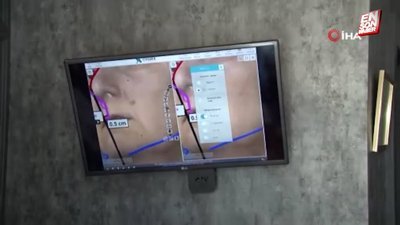 Yabancılar burun estetiği için Türkiye'yi tercih ediyor