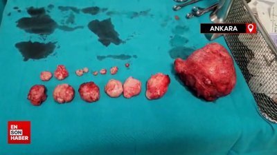 Ankara'da rahminden 16 tümör çıkarıldı