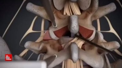 Bel fıtığı çıkarılma ameliyatı