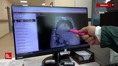 Dünyada ilk olan bir vaka Giresun Sendromu adıyla tıp literatürüne girdi