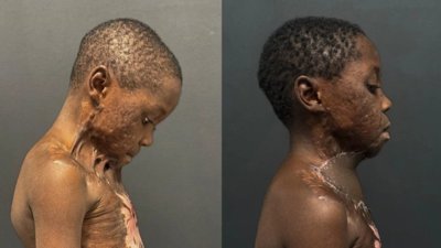 Kamerun’da boynu yanıp çenesi gövdesine yapışan çocuk Türkiye'de şifa buldu