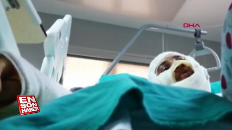 Yüzü yakılan kadın, verdiği tepkiyle şaşırttı 