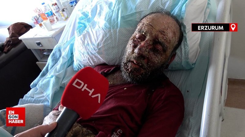 Koronavirüs geçirdikten 1 sene sonra yüzü tanınmaz hale geldi