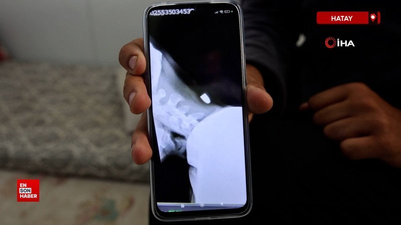 Hatay'da ensesine yorgun mermi isabet eden genç, 2 santimle ölümden döndü