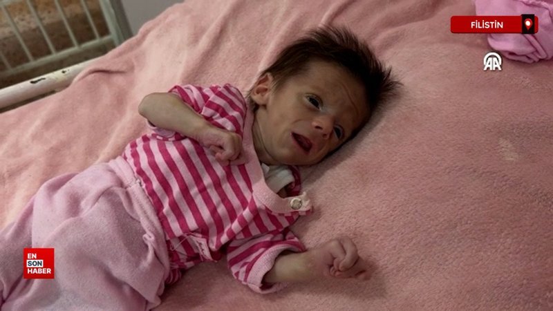 Gazze'de çocuklar yetersiz beslenme ile mücadele ediyor